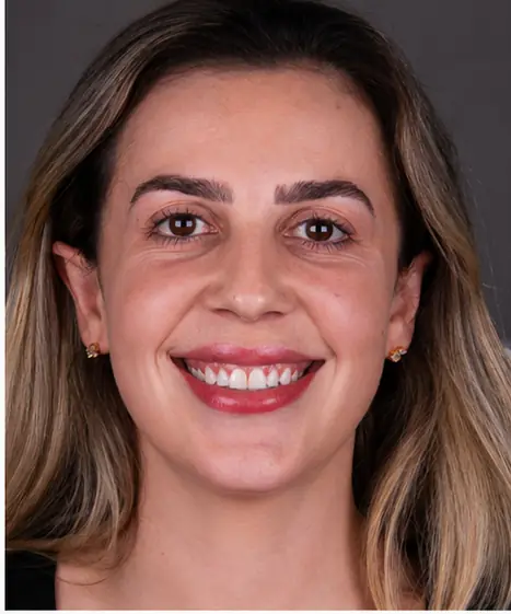 Anterior Veneers — antes