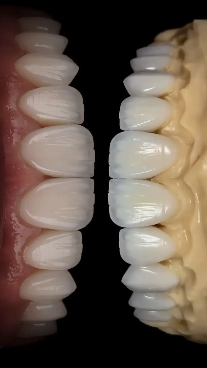 Posterior Crown