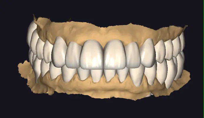 Bimaxillary Wax-up