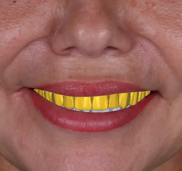 Full-Arch Implant Bridge