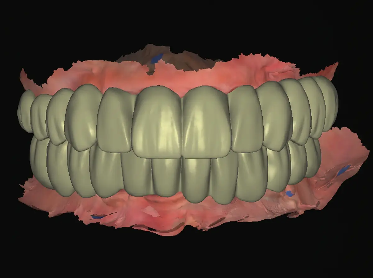Anterior Veneers